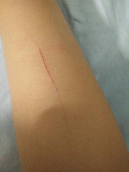 被狗狗抓伤怎么办