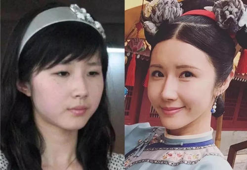 为什么整容脸会老得快