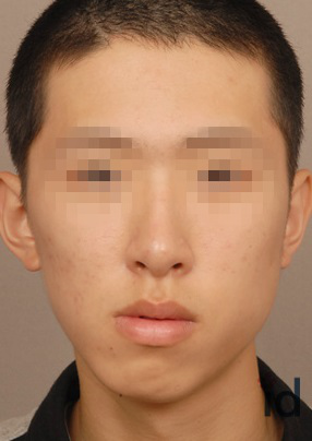 瘦脸针的危害有什么副作用